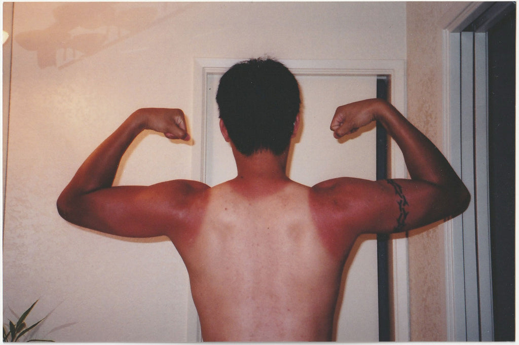 Man with Sunburn Flexing Biceps